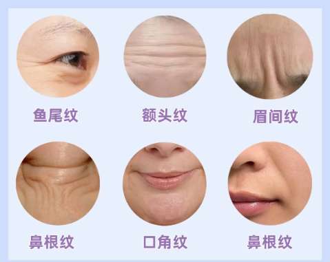 除皱 除皱