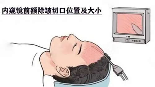 除皱 除皱