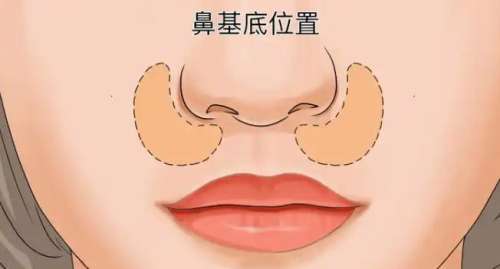 玻尿酸鼻基底填充.jpg 玻尿酸鼻基底填充.jpg