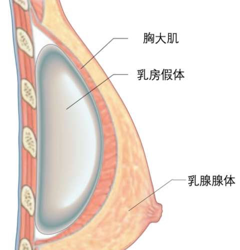 隆胸 隆胸
