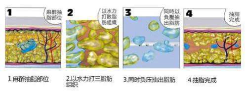 水动力吸脂减肥2.jpg