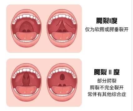 唇腭裂 唇腭裂