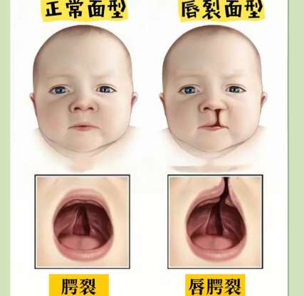 唇腭裂 唇腭裂
